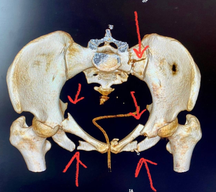 Медики помогли омичке с переломом таза быстро встать на ноги