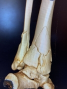 Омские травматологи прооперировали женщину с переломом ноги